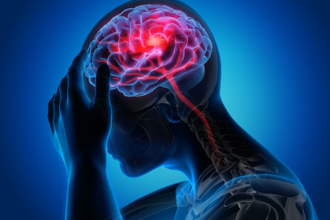 Nearly 70% of Strokes Have This Risk Factor In Common, New Study Says