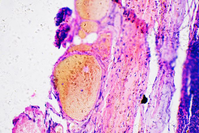 New Research: Asthma and Allergies May Spike Your Risk of This Cancer