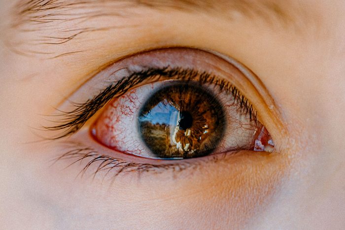 What Is Commonly Misdiagnosed as Pink Eye? An Expert Eye Doctor Shares the List