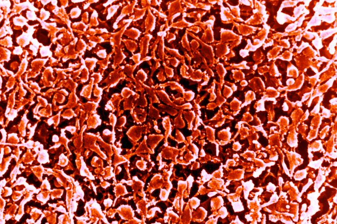What Is Walking Pneumonia and How Contagious Is It? Expert Doctors Reveal
