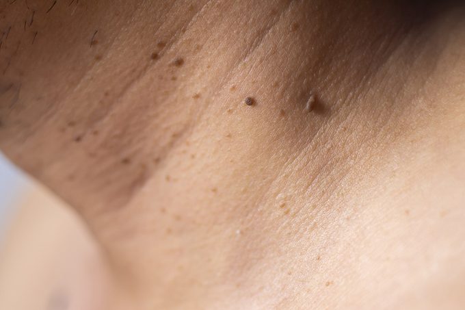 How to Get Rid of Skin Tags the Right Way, According to Expert Dermatologists