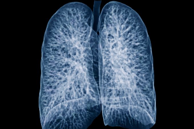 More Than 80% of People Who Need This Cancer Screening Aren’t Getting It