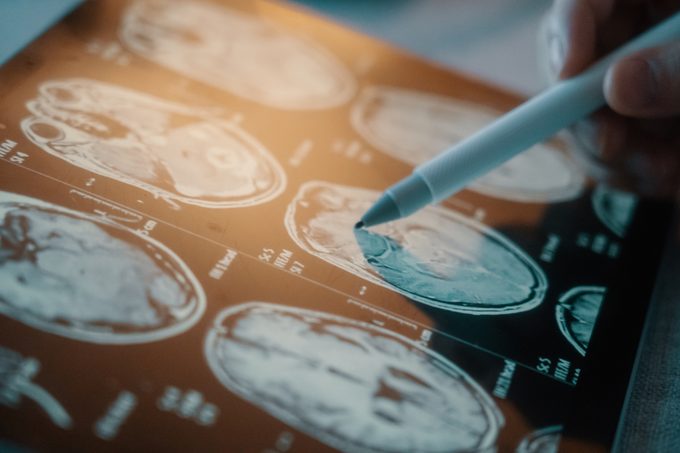New Study: This Common Procedure May Increase Cancer Risk